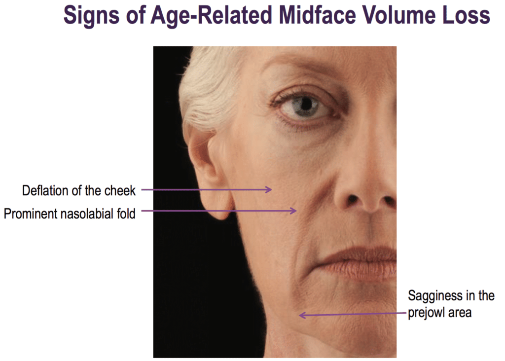 Sings of Age-related midface volume loss