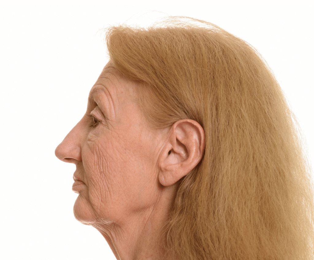 Jowls are loose, sagging skin along the jawline which in some cases can be softened in appearance with filler injections