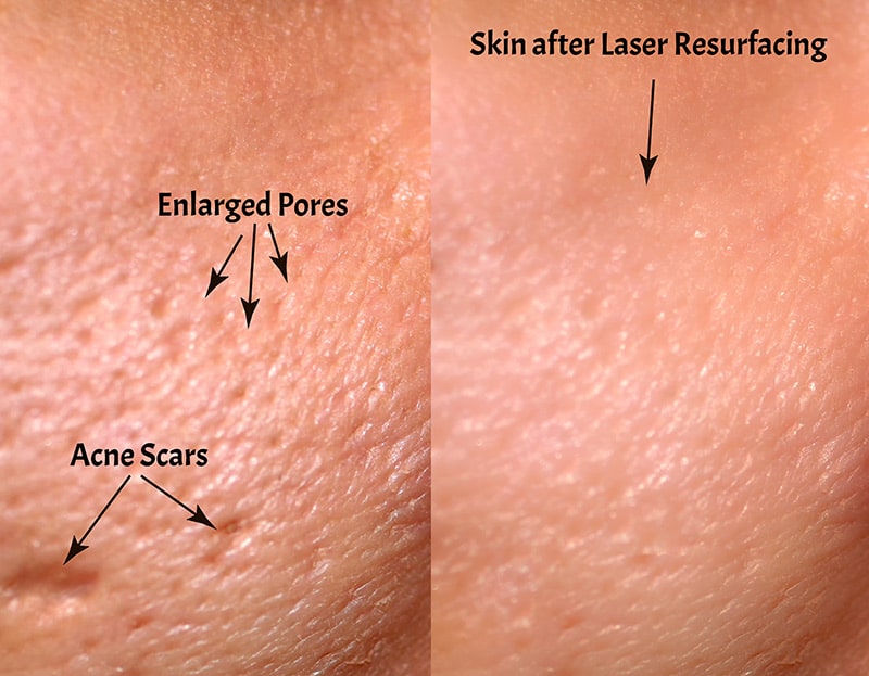 Acne scar and large pore improvement with laser resurfacing