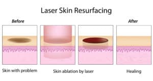 CO2 Laser Resurfacing | Erbium laser Washington DC and Virginia