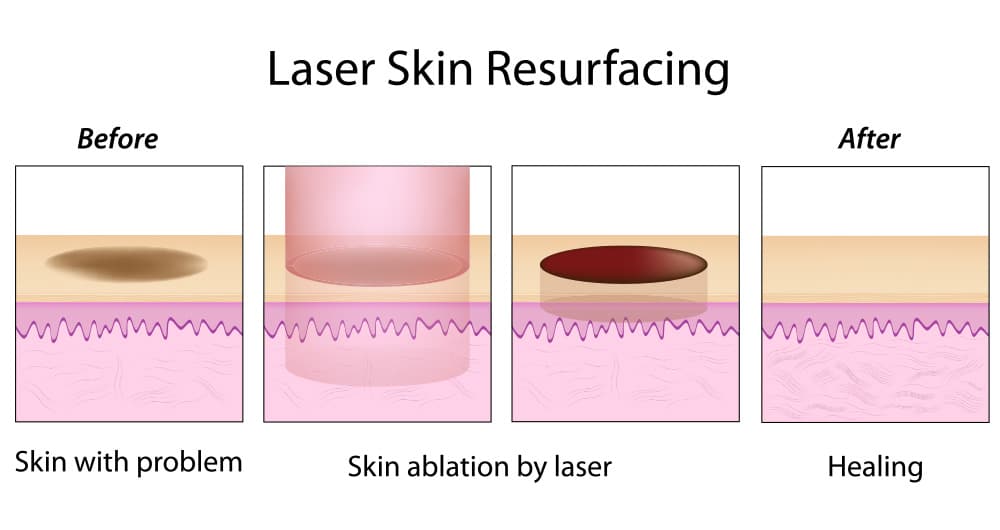 Ablative lasers are also sometimes referred to as wounding lasers and produce the most dramatic facial rejuvenation results.