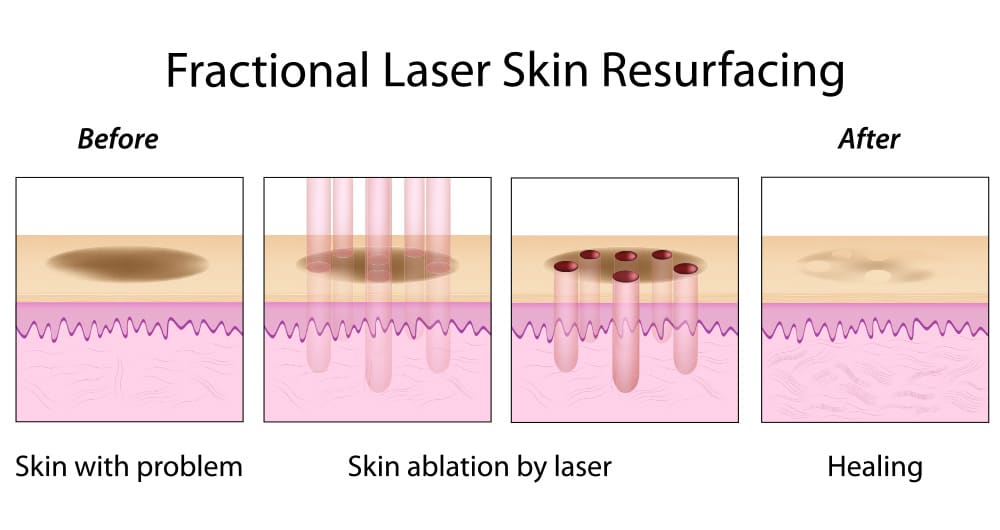 Ablative fractionated lasers emit heat and energy into the skin through thousands of tiny, narrow, deep microscopic columns of laser light. 