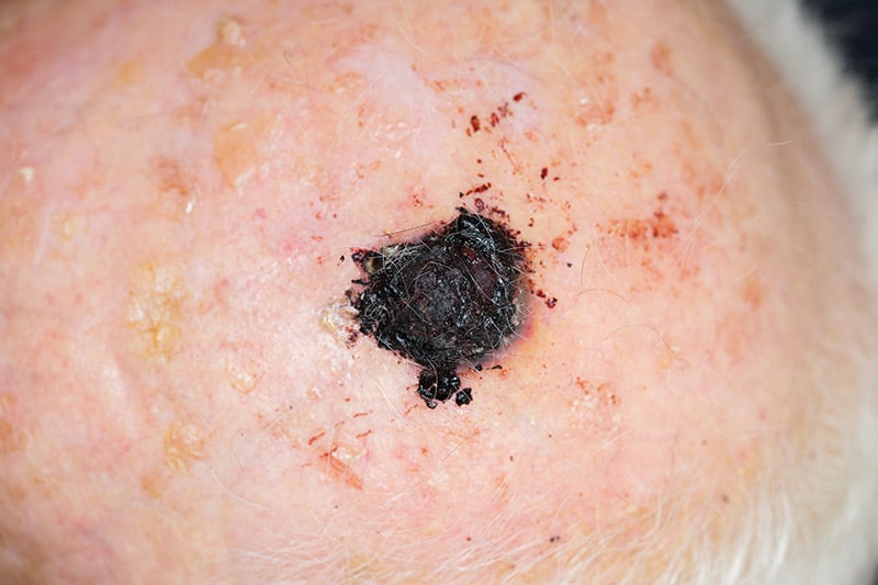 Malignant melanoma can appear acutely as an independent lesion or it can form from existing moles.