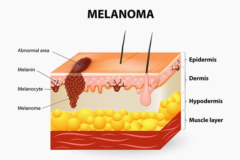 Melanoma originates from the melanocytes, The Naderi Center for Plastic Surgery and Dermatology | Virginia | Maryland  
