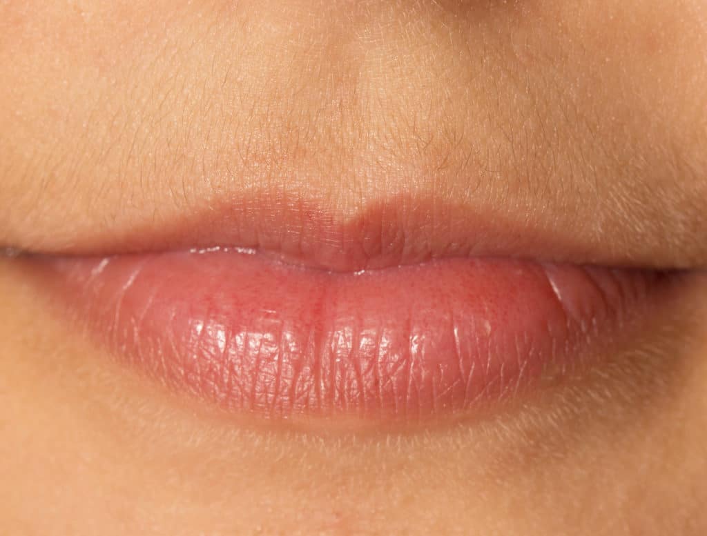 The small upper lip can be augmented with fillers to create a more balanced lip