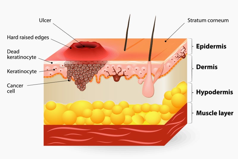 This type of carcinoma often appears irregularly shaped, pink, and scaly in areas like the lips and body. 