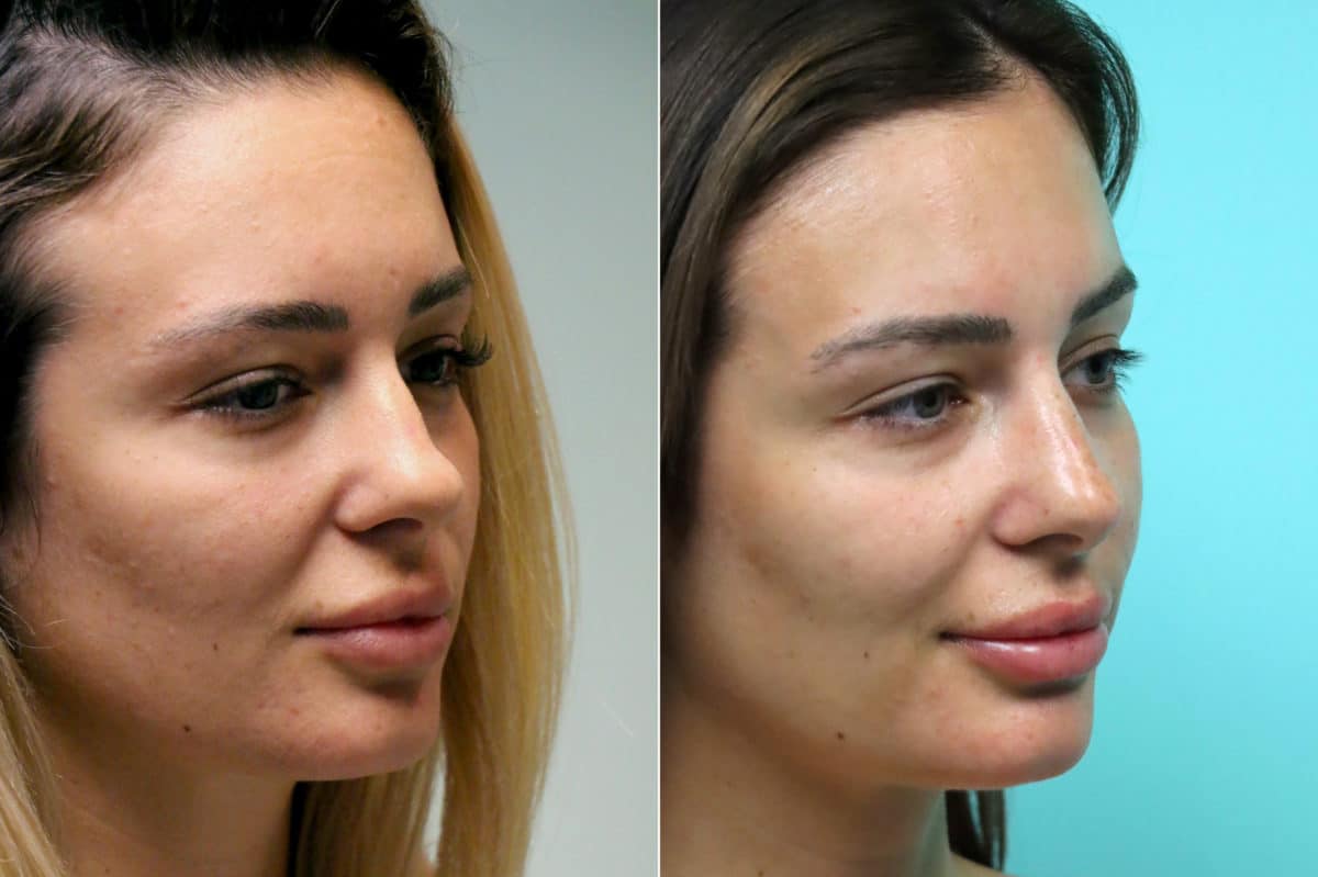 Before and after Injections by Dr. Shervin Naderi, Patient 17129