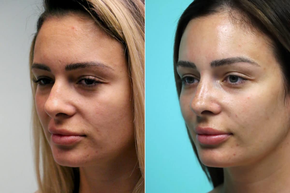 Before and after Injections by Dr. Shervin Naderi, Patient 17129