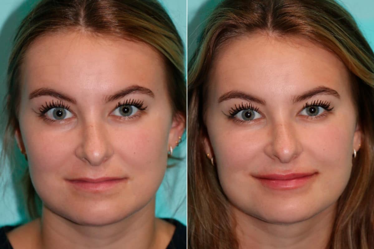 Lip Plastic Surgery Before And After Hot Sex Picture