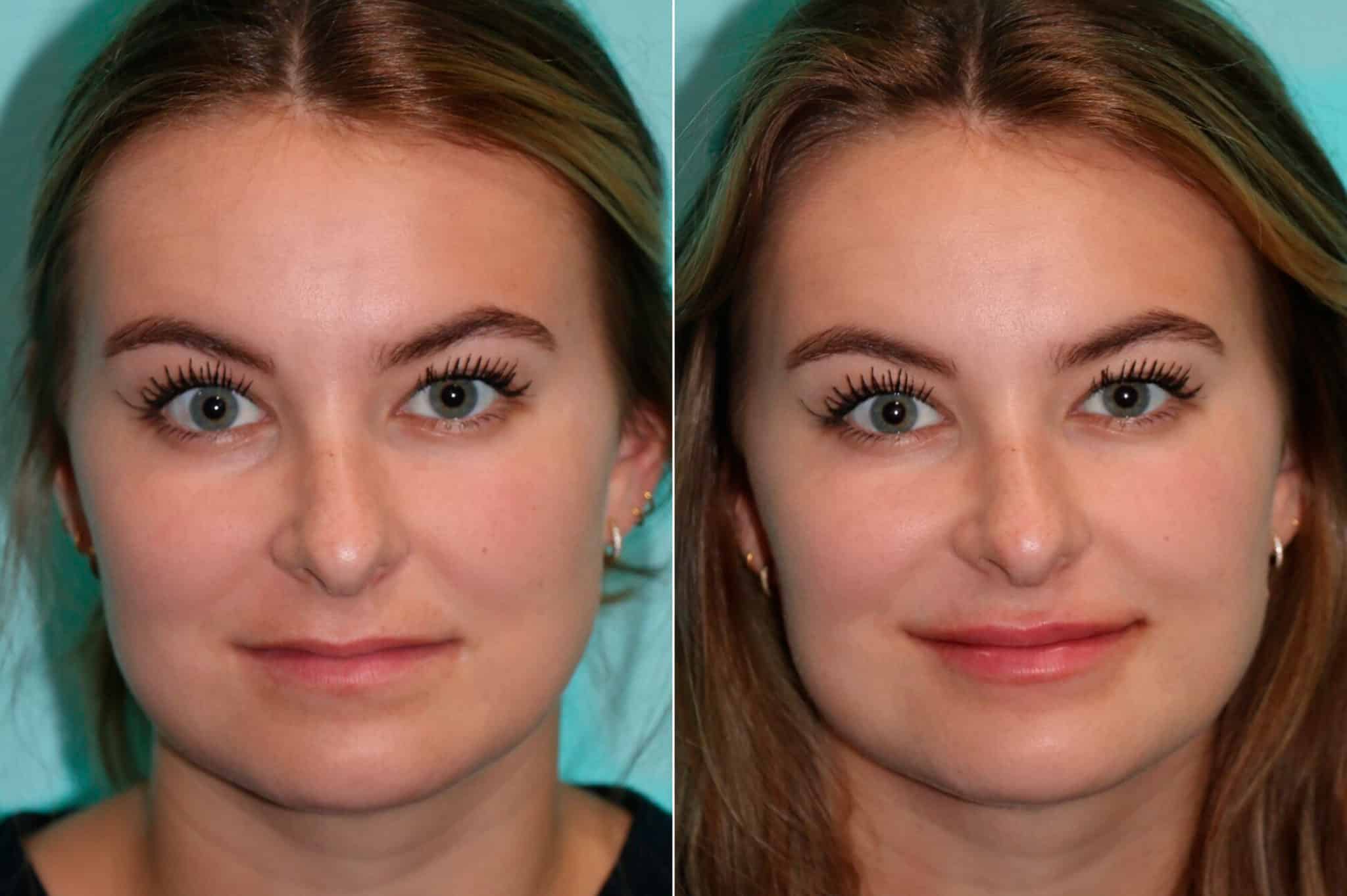 Lip Augmentation photos Chevy Chase, MD Patient 17093