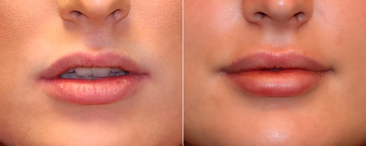 Before and after Lip Augmentation by Dr. Shervin Naderi, Patient 17306