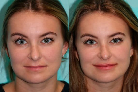 Before and after Lip Augmentation by Dr. Shervin Naderi, Patient 17093