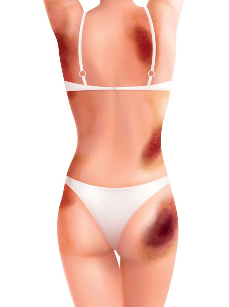 Liposuction Bruising: Understanding the Healing Process