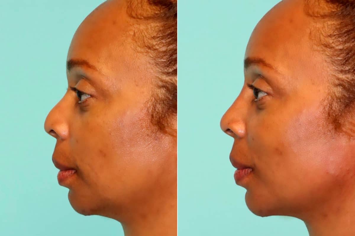 Before and after Non-Surgical Rhinoplasty by Dr. Shervin Naderi, Patient 17116