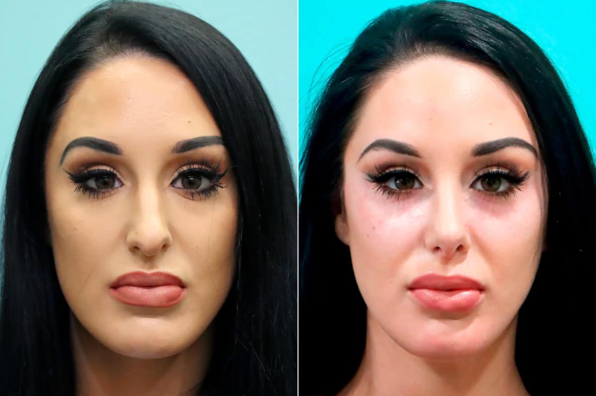 Before and after Rhinoplasty by Dr. Shervin Naderi, Patient 17091