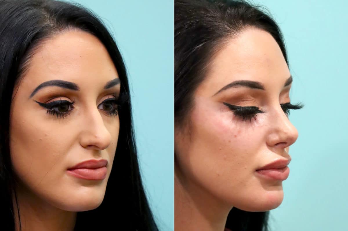 Before and after Rhinoplasty by Dr. Shervin Naderi, Patient 17091