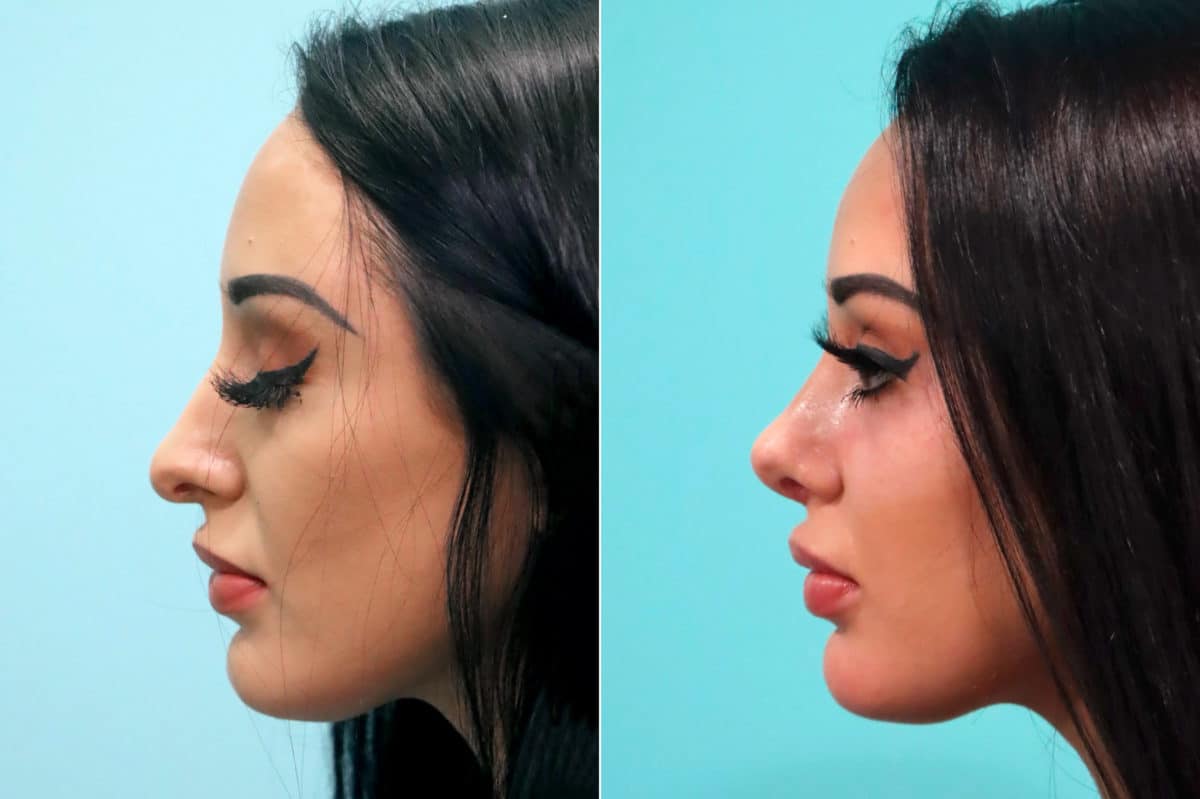 Before and after Rhinoplasty by Dr. Shervin Naderi, Patient 17091