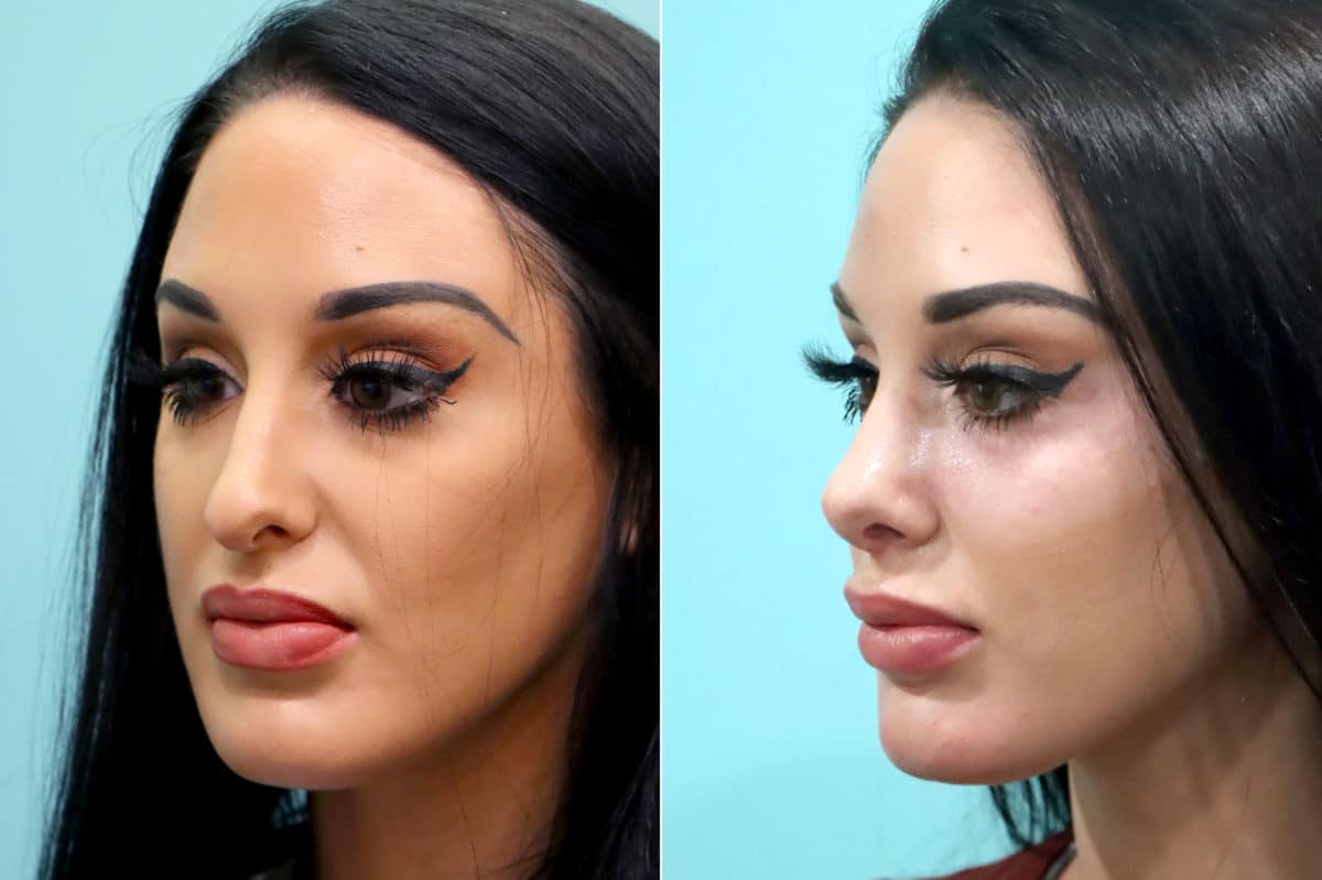 Before and after Rhinoplasty by Dr. Shervin Naderi, Patient 17091