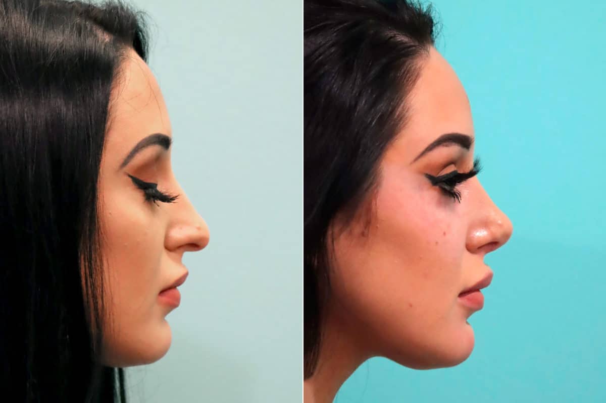 Before and after Rhinoplasty by Dr. Shervin Naderi, Patient 17091