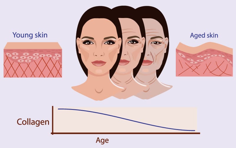 Botox will still be needed to relax the muscles responsible for the wrinkles but additionally dermal fillers like Restylane or Juvederm may also be needed to plump up and smooth out the deep wrinkles.