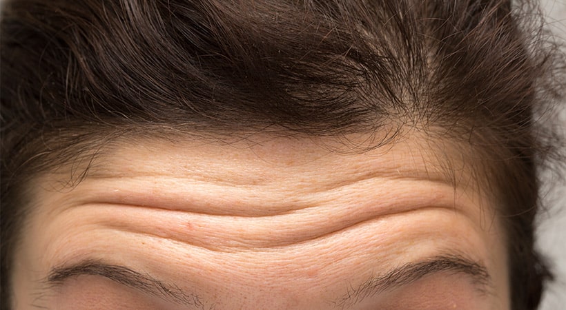 Deep forehead wrinkles can be fixed with filler at The Naderi Center in Virginia and Maryland