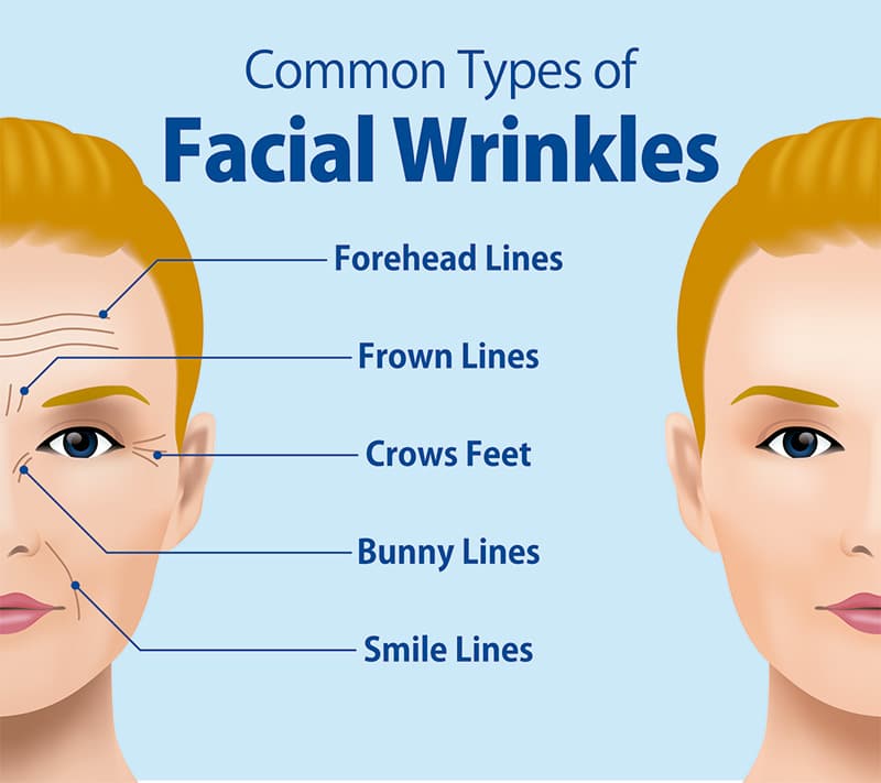 Diagram demonstrating most common areas of fine lines and wrinkles that can be treated with Botox and fillers