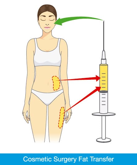 Fat grafting is a technique that involves removing a patient's own fat and injected into another area of the body.