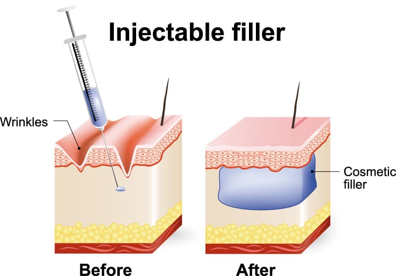 The most important decision patients make when pursuing filler injections is selecting a well experienced medical provider. 