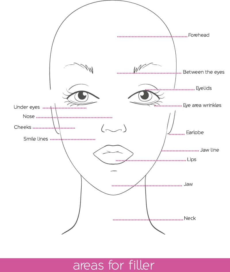 After Fillers injections the expected results are Improvement in the  appearance of lip lines and 
Enhancement of lip volume and shape