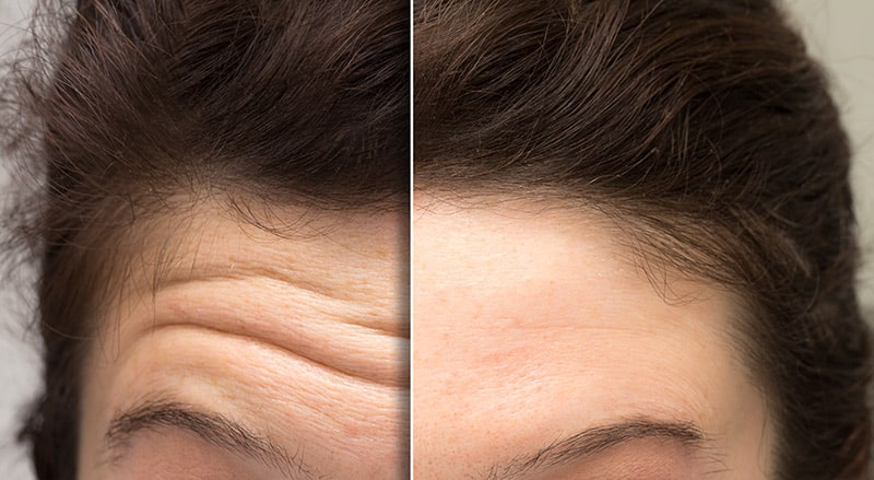 Before and after photos of Botox injections offered at The Naderi Center in Virginia and Maryland