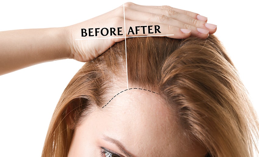 Good Candidates for PRP Injections for Hair Loss are in the earlier stages of hair loss