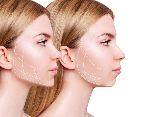 Jaw line contouring with fillers can create better jaw definition and create a more slim appearing face