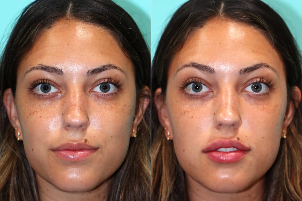 Lip Augmentation Photos Chevy Chase Md Patient 17568