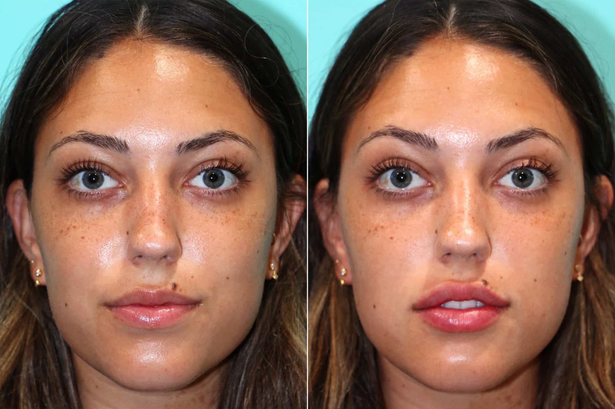 Lip Augmentation photos | Chevy Chase, MD | Patient 17568