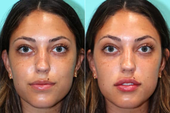 Before and after Lip Augmentation by Dr. Shervin Naderi, Patient 17568