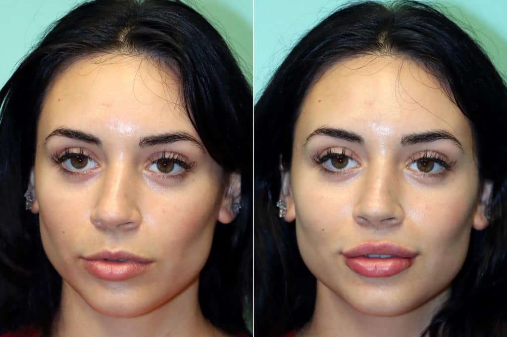 Lip Augmentation photos Chevy Chase, MD Patient 17548
