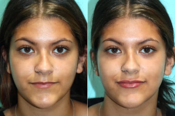 Before and after Lip Augmentation by Dr. Shervin Naderi, Patient 17659