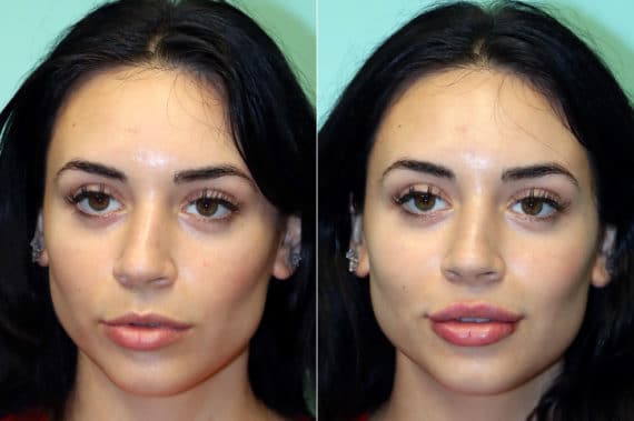 Before and after Lip Augmentation by Dr. Shervin Naderi, Patient 17548