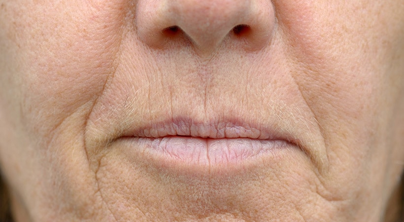 Lines running from the mouth towards the chin, or “marionette lines”, can be corrected with dermal filler injections