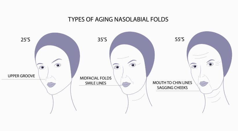 Nasolabial folds are the deep lines around both sides of the mouth and become more evident when smiling.