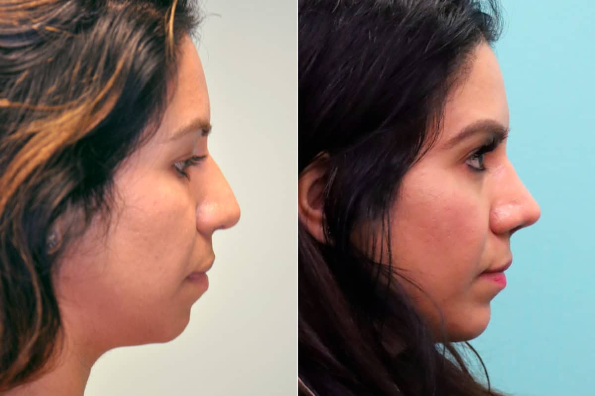 Before and after Chin & Facial Implant by Dr. Shervin Naderi, Patient 17613