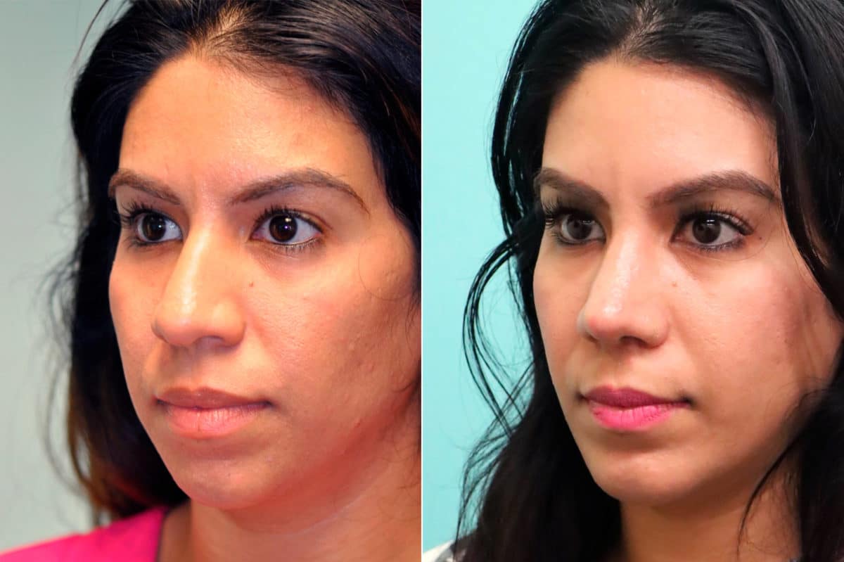 Before and after Chin & Facial Implant by Dr. Shervin Naderi, Patient 17613