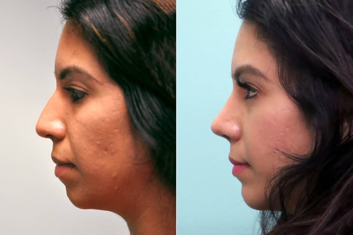 Before and after Chin & Facial Implant by Dr. Shervin Naderi, Patient 17613