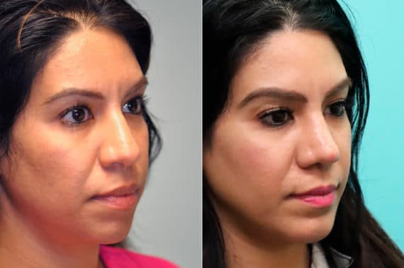 Before and after Chin & Facial Implant by Dr. Shervin Naderi, Patient 17613