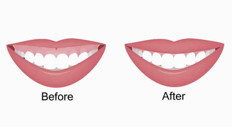 Dysport can reduce appearance of a gummy smile