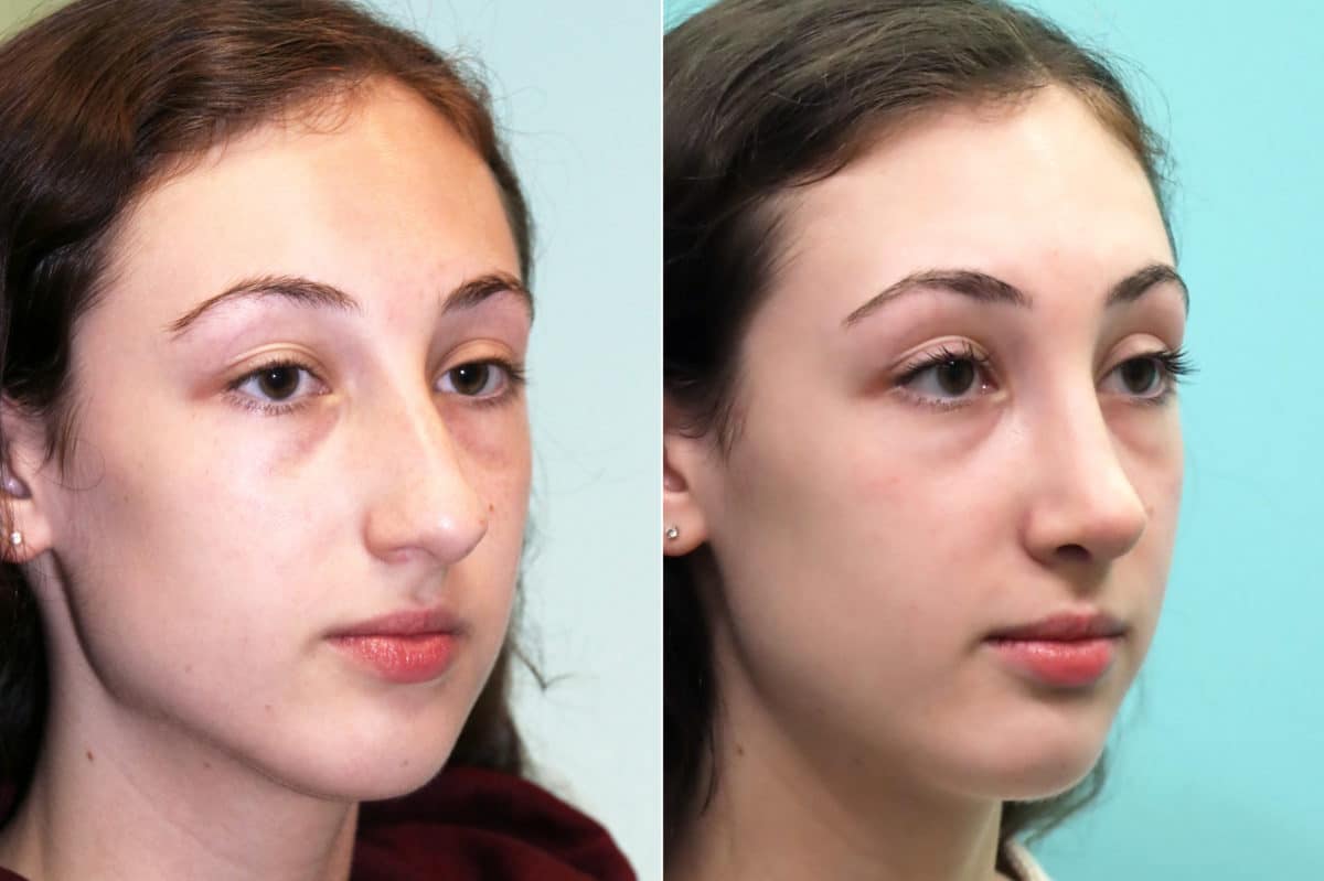 Before and after Rhinoplasty by Dr. Shervin Naderi, Patient 17549