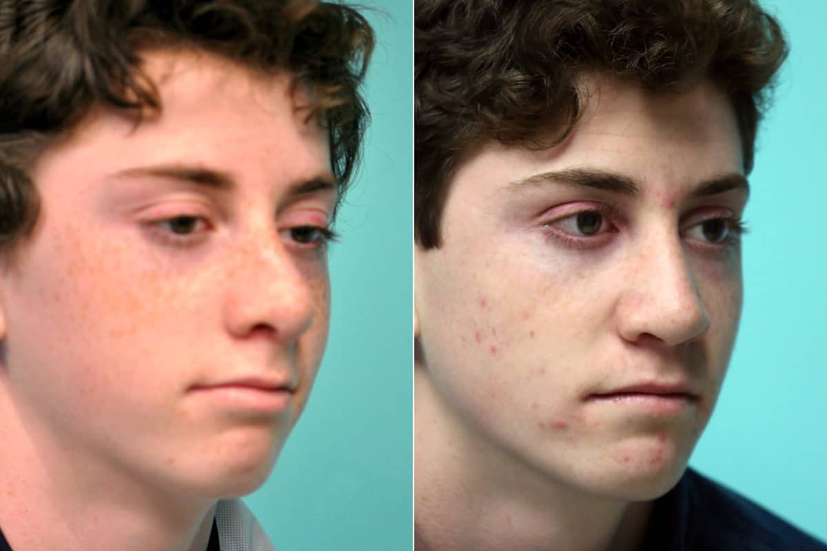 Before and after Rhinoplasty by Dr. Shervin Naderi, Patient 17592