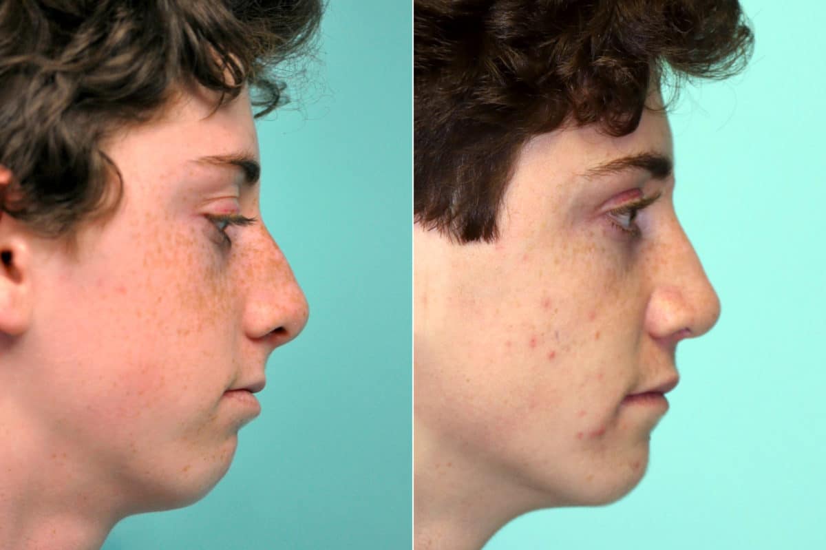 Before and after Rhinoplasty by Dr. Shervin Naderi, Patient 17592