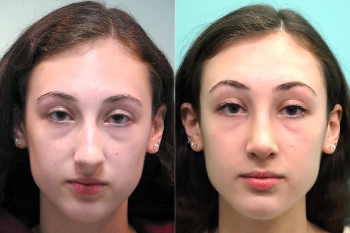 Before and after Rhinoplasty by Dr. Shervin Naderi, Patient 17549