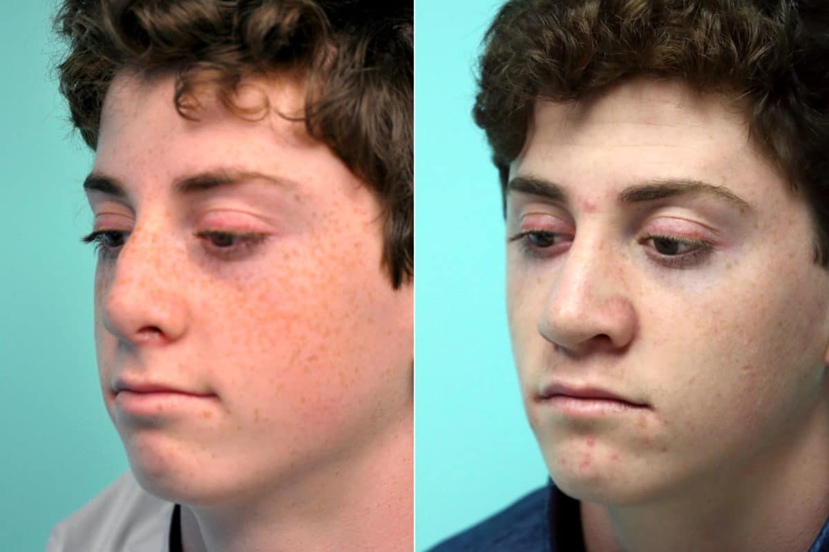 Before and after Rhinoplasty by Dr. Shervin Naderi, Patient 17592